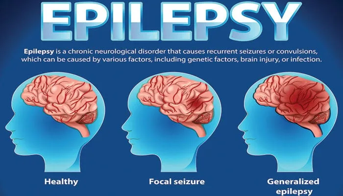 What Is Epilepsy? The Silent Storm in the Brain 1 1000078995